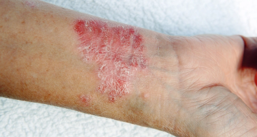 Symptômes de l’eczéma atopique sur l'avant-bras d'un patient